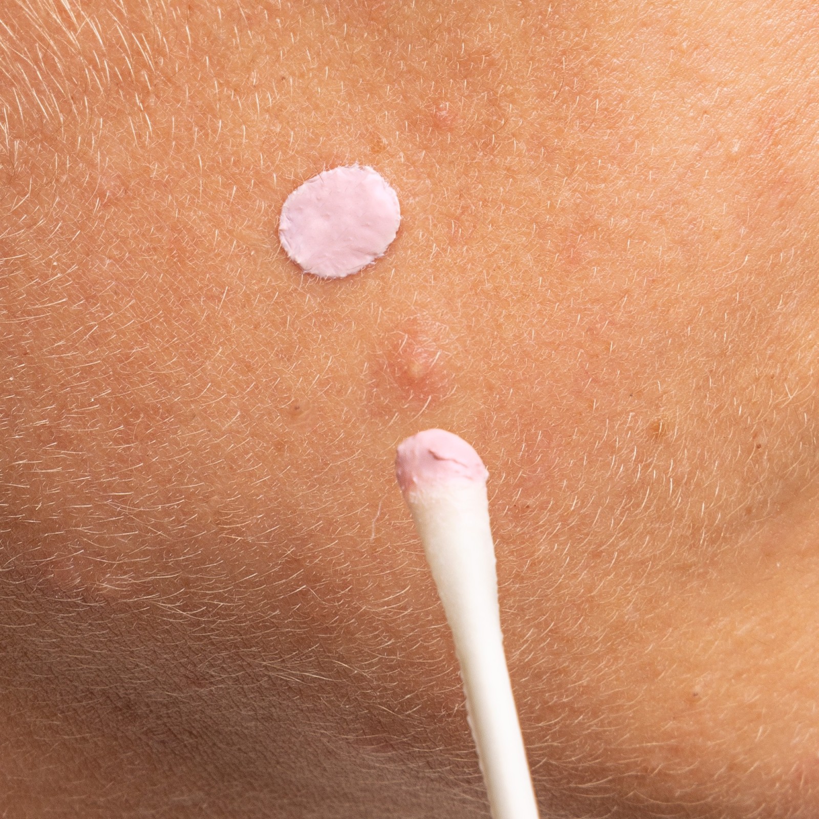 Goodbye Blemish Pink Spot - Mizon | MiiN Cosmetics